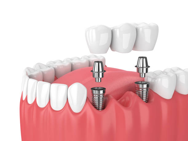 Optimal Oral Hygiene: Elevating Dental Care Standards